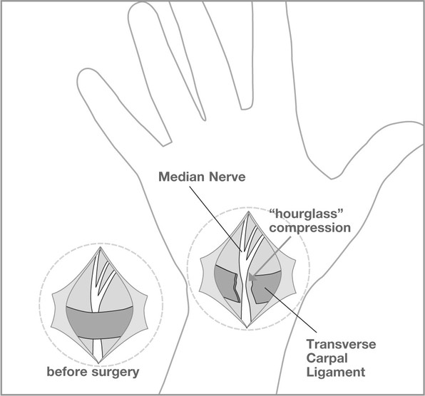 Carpal_Image3